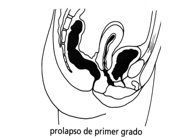 Prolapso de primer grado