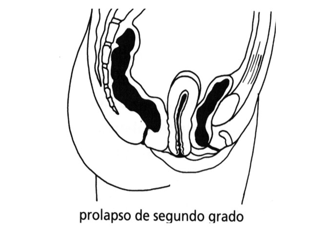 Prolapso de segundo grado