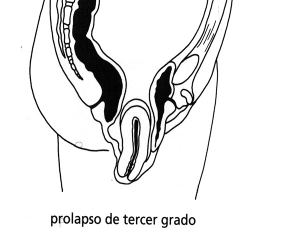 Prolapso de tercer grado